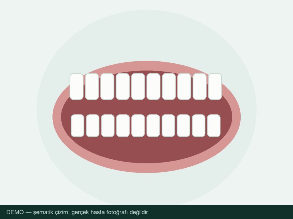 Tek diş implant — tedavi sonrası